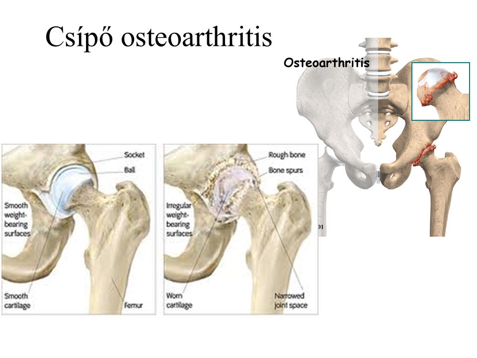 fokú csípőízületi osteoarthritis a csípőízület konzervatív kezelése